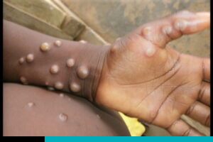 mpox