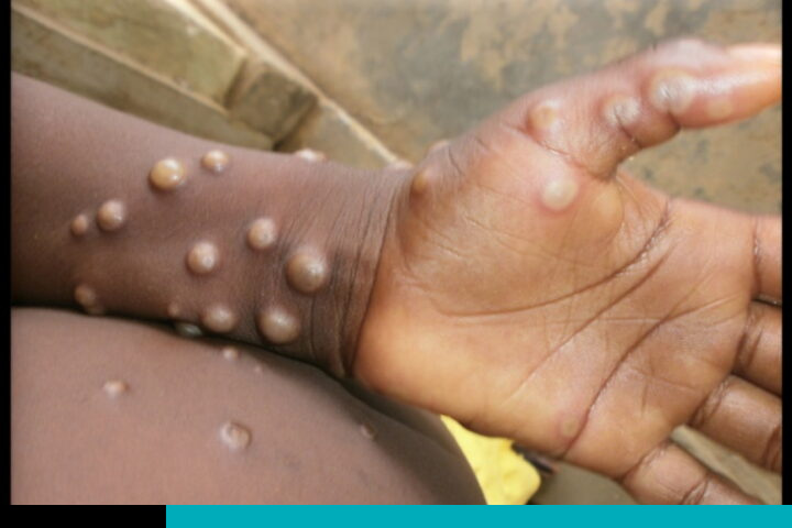 mpox