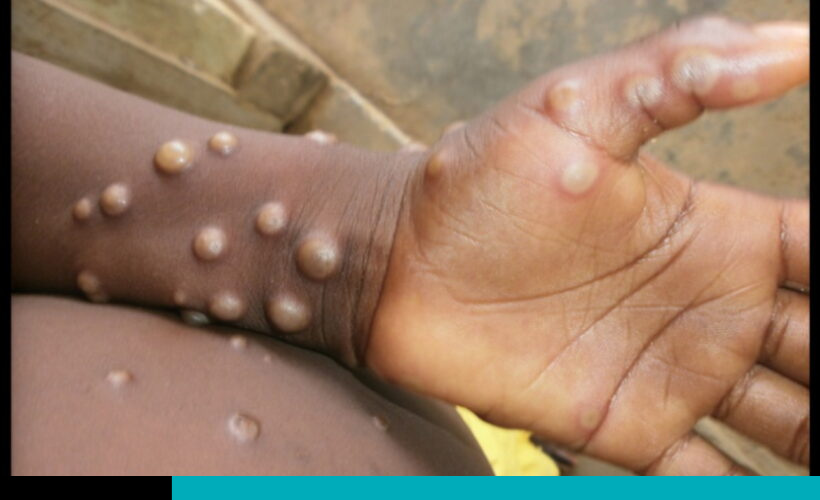 mpox