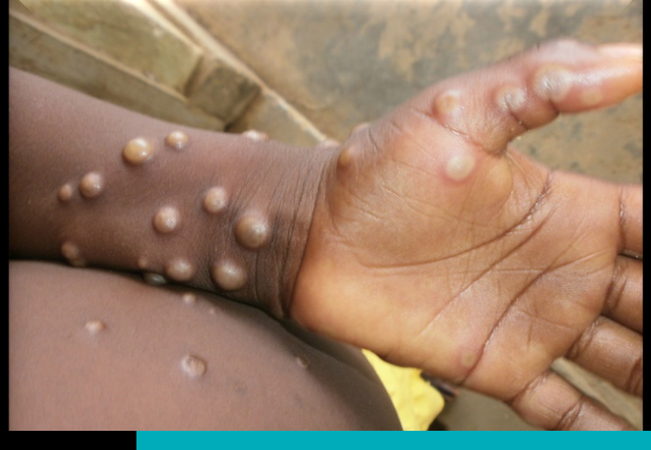 mpox